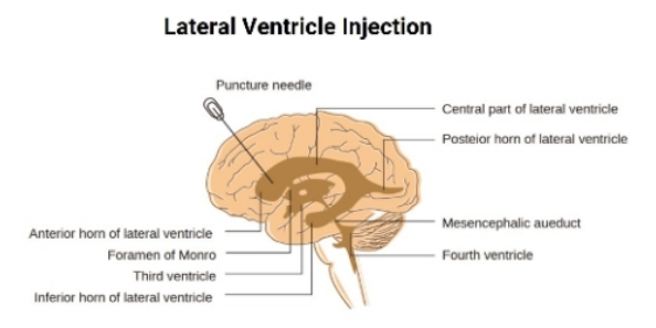 Is Intrathecal Administration Safe?